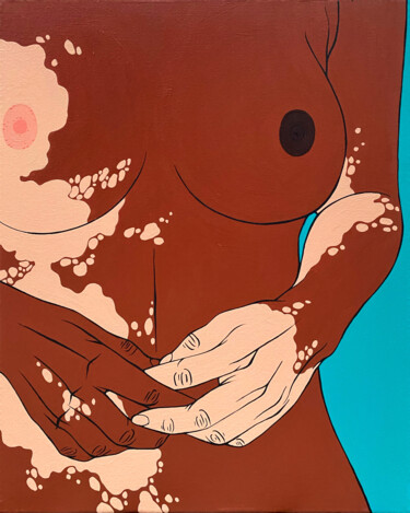 Schilderij getiteld "Gerda / Vitiligo be…" door Sviatlana Petushkova, Origineel Kunstwerk, Acryl Gemonteerd op Frame voor ho…