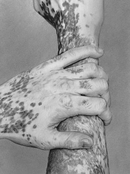 Drawing titled "Vitiligo" by Marion Roy, Original Art, Pencil